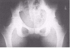 FIGURE 36: DE LA WARR RADIONIC PHOTOGRAPH OF PELVIS